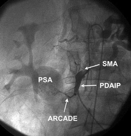 Selektivna angiografija a. pancreaticoduodenal inferior posterior (PDAIP) iz SMA. Pseudoaneurizma (PSA) u nivou anastomoze (arkade) PDAIP i a. pancreaticoduodenal superior anterior.