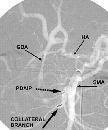 pancreaticoduodenal inferior posterior (PDAIP) (isprekidana strelica) a jedna u kolateralnu arterijsku granu.