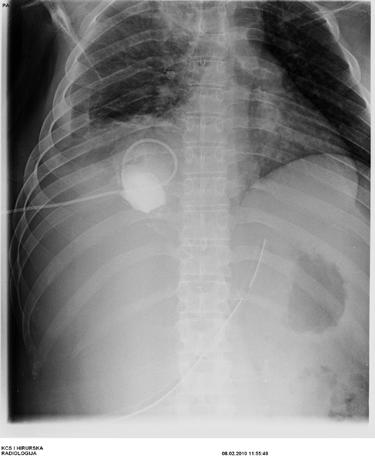 c) d) Slika 4. Pacijent u životnoj dobi od 29 godina. Stanje nakon prednje niske resekcije rektuma pp Ca recti i višestruke metastazektomije u jetri.