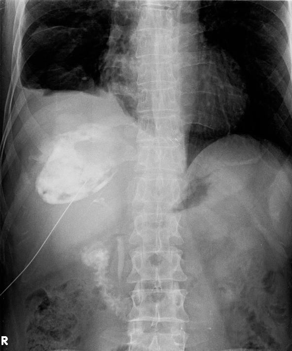a) b) Slika 10. Isti pacijent. a) Kontrastna radiografija učinjena nakon dijagnostičke punkcije i aspiracije abscesa.