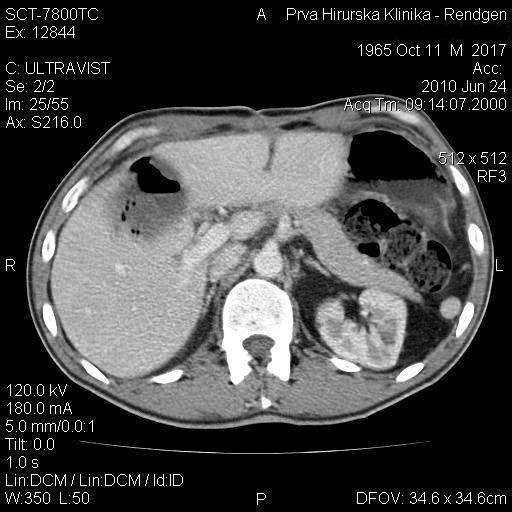 Slika 14. Pacijent star 46 godina. Stanje nakon subsegmentektomije zbog metastatske promene u jetri.