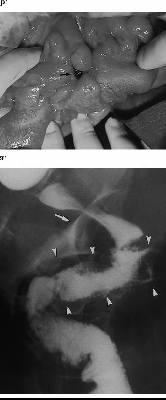 Slika 2. a) Karcinom rektosigmoidnog prelaza.urađena proktografija. Vidi se plasiran stent, koji je potpuno ekspandiran i prolazan ( glave strelica).