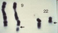 Milestones in the history of CML 1960: Abnormal chromosome 22 (Philadelphia chromosome) identified and associated with CML 1973: Translocation 9;22 defined 1983: Molecular studies of fusion