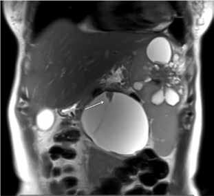Also, low-density solid nodulr lesion is oserved in the spleen (rrows).