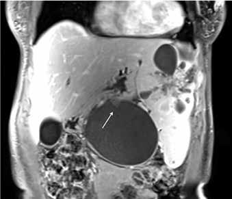 centrl cystic lesion. It is not cler whether it origintes in the spleen or the pncres.