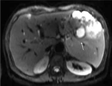 Sequence with coronl T2 informtion: ) It shows splenic cystic lesions of high signl