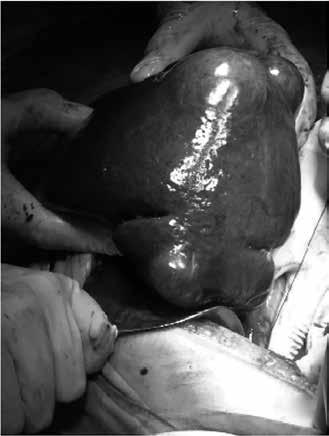 Figure 3. () Surgicl specimen: Enlrged spleen, loulted contours y solid nd cystic lesions.