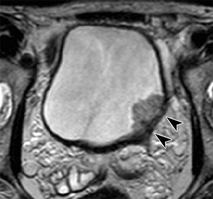 Urinary Bladder Cancer: Diffusion-weighted MR Imaging