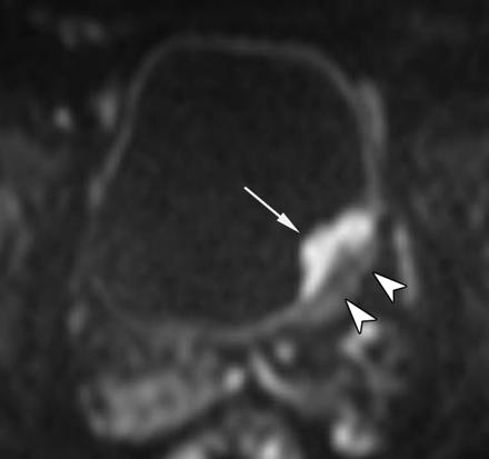Urinary Bladder Cancer: Diffusion-weighted MR Imaging Accuracy for Diagnosing T Stage and Estimating Histologic