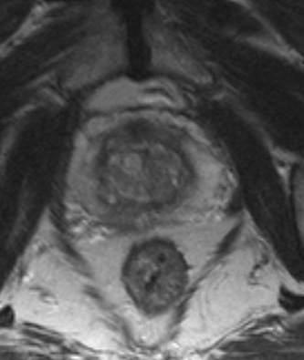 KLASSIKALINE PROSTATA VÄHK MRT T2 - hüpointensiivne (tume ala) NORMAALNE PERIFEERNE TSOON - hüperintensiivne (hele) prostatiit