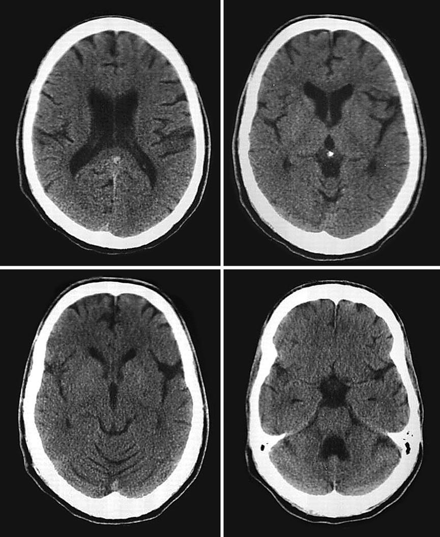Images obtained in the patient with homozygous ATP13A2 mutation, after 10 years of disease course. A diffuse moderate atrophy is evident in both the cerebral and cerebellar structures.