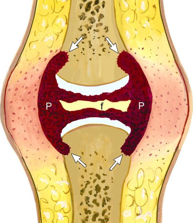 Radioloogilised tunnused: Pehmekoeline turse Periartikulaarne osteopeenia Erosioonid (algul