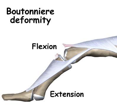 hüperekstensioon PIF ja fleksioon DIF liigestes Boutonniere`i deformatsioon: fleksioon PIF ja