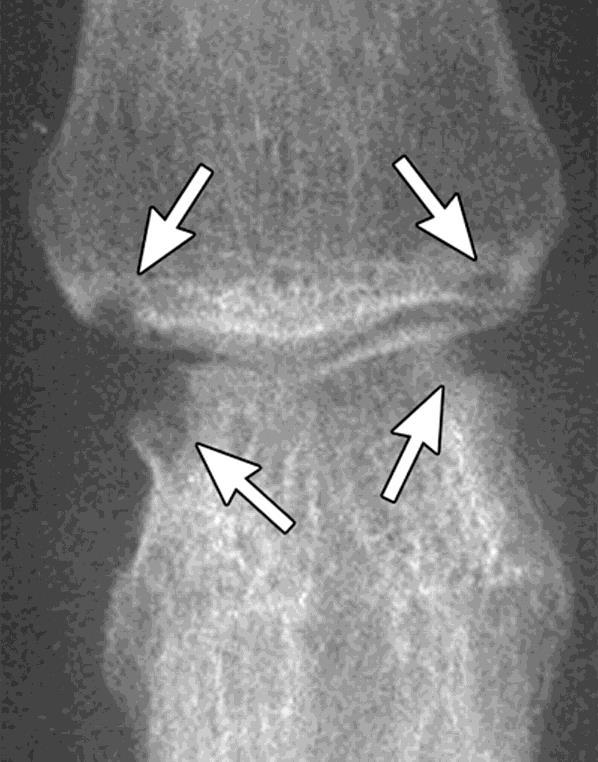 Reumatoidartriit Osteoartroos Osteopeenia Liigespilu kitsenemine Pehmete kudede turse Erosioonid (servades)