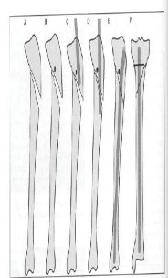 Materials and Methods We studied retrospectively 60 fractures of tibial shaft in 60 patients between July 2008 and December 2014 (48 male and 12 female) with mean age of 34 ± 1years (19 to 49).