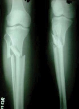 JA 40 3 30 2 20 1 10 0 Series1 Figure 3 Closed proximal tibial fracture.