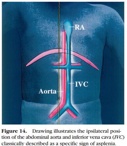 Asplenia/Right isomerism/bilateral rightsidedness/ivemark syndrome Asplenia (rudimentaarne põrn), keskjoone maks, ipsilateraalne aort ja IVC, mõlemas kopsus 3 sagarat.