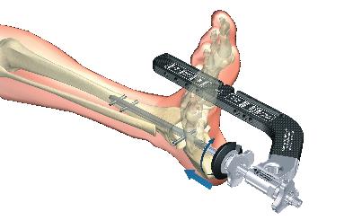 Step 4 (optional): Talo-calcaneal external compression External compression is achieved by inserting the Apposition Ring (1806-3204) over the Apposition Handle (1806-3215).