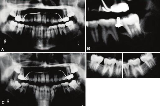 Fig. 2 Case 1. A. 13-year-old male with bilateral impacted mandibular second and third molars. B.