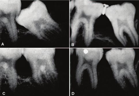 Patient one year later, showing root development and mesial bone fill. Fig. 3 Case 2. A.