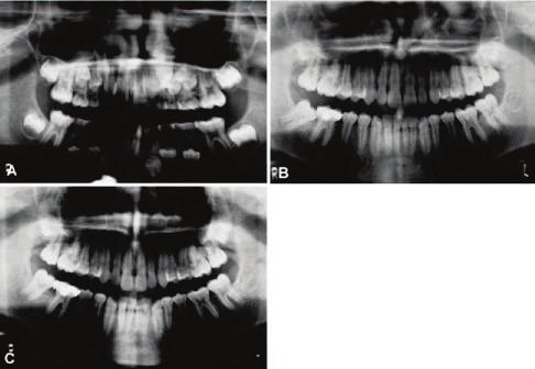 Fig. 4 Case 3. A. 8-year-old male beginning early treatment, with apparently normal second molars and no visible third molar buds. B. Patient at age 13, with impacted mandibular right second molar. C. Six months after surgical uprighting, with brass wire in place, showing rapid bone fill (first molar band is from earlier lingual arch).