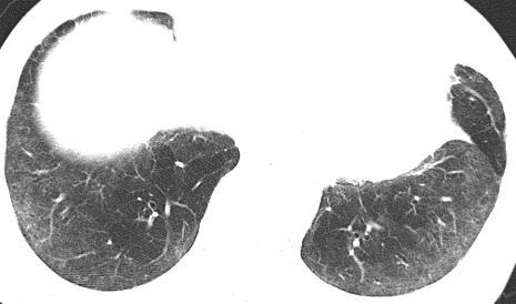ground-glass opacity, related to interstitial inflammation Perivascular cysts: mid lung zones and