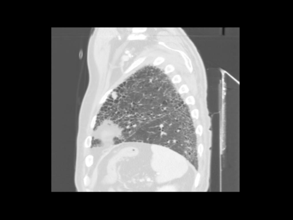 Fig. 7: HRCT coronal of a patient with RA. Solid subpleural nodule, 15 mm of diameter, in the anterior segment of the left upper lobe, consisting of a rheumatoid nodule. Fig.