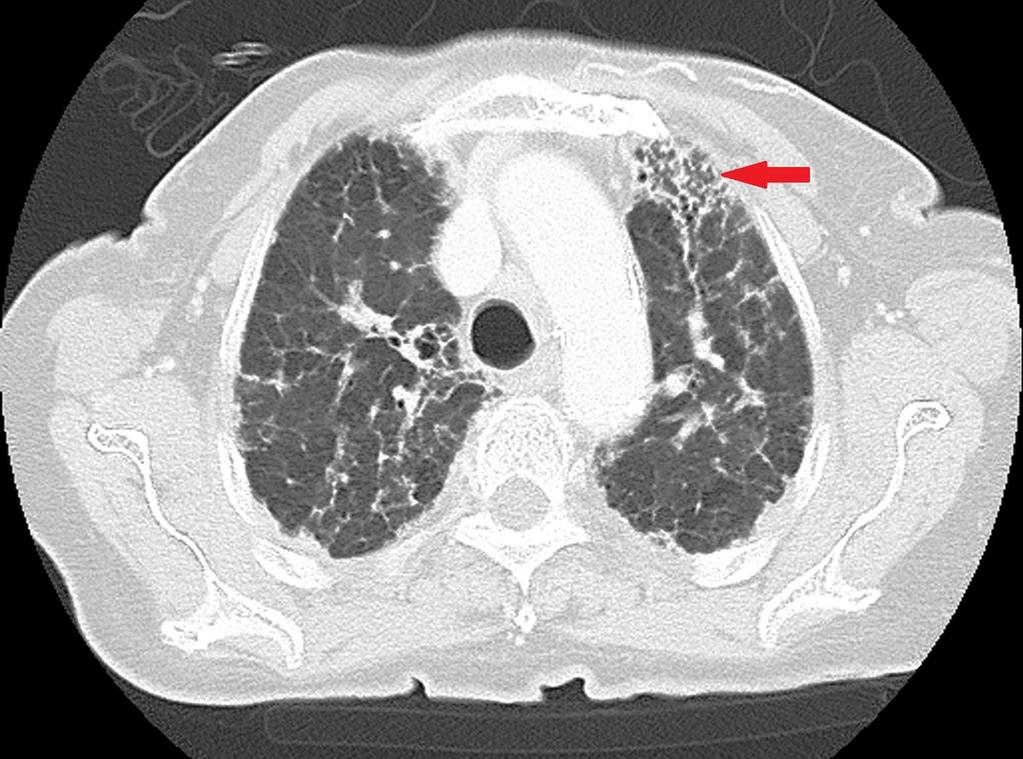 Fig. 2: Axial HRCT of a patient with RA shows pulmonary fibrosis with honeycombing (red arrow),