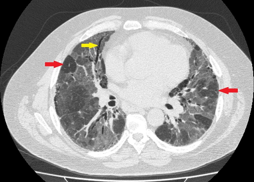 Fig. 3: Axial expiratory HRCT of a patient with RA shows large regions of air-trapping (red arrow) secondary to RA-related constrictive bronchiolitis.