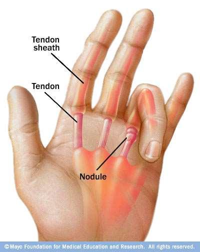 Common Flexor Pathology Trigger finger Smooth gliding of flexor tendon is disrupted due