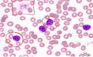Peripheral blood smear Lymphocytosis Low platelets Size and shape of red blood cells Quantity