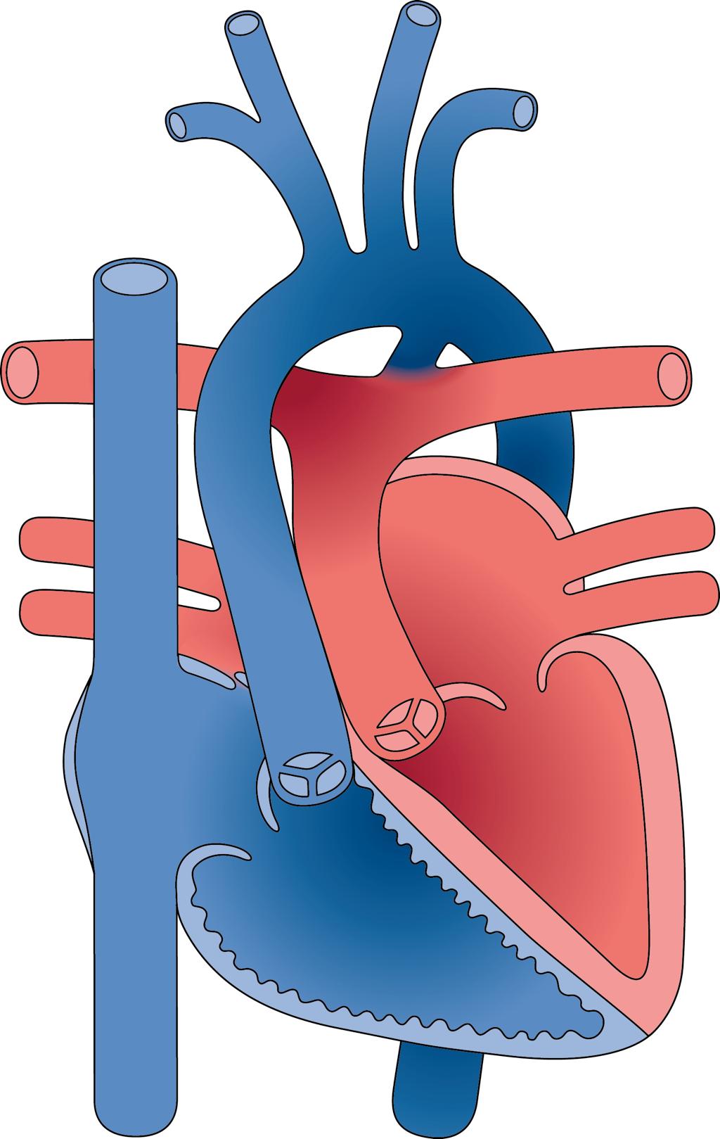 Complex congenital heart