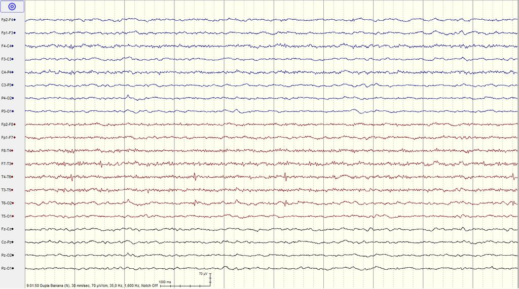 Slika 10. EEG bolesnice pred otpust - nalaz poboljšan u odnosu na početni. Niže do srednjevoltažna osnovna cerebralna aktivnost je u delta aktivnosti.