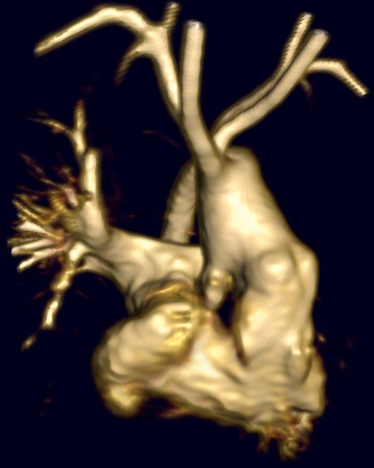 pulmonary artery root and native aorta Bi-direction Glenn