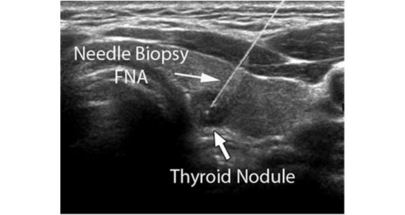 Nodule Characteristics Size Echogenicity (how dark/dense) Roundness Blood flow/vascularity Calcifications Cystic component Size Solid nodules hypoechoic 1 cm cutoff Isoechoic or