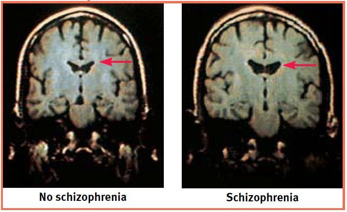Understanding Schizophrenia Brain Abnormalities Abnormal Brain Activity and