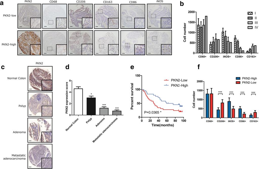Cheng et al. Molecular Cancer (2018) 17:13 Page 3 of 16 Fig. 1 Overexpression of PKN2 is associated with better clinical outcome and high M1 content in human colon cancer.