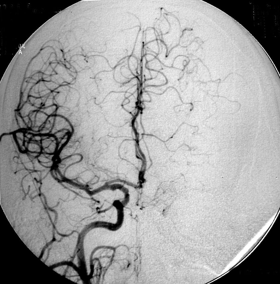 Embolic occlusion of left middle cerebral artery