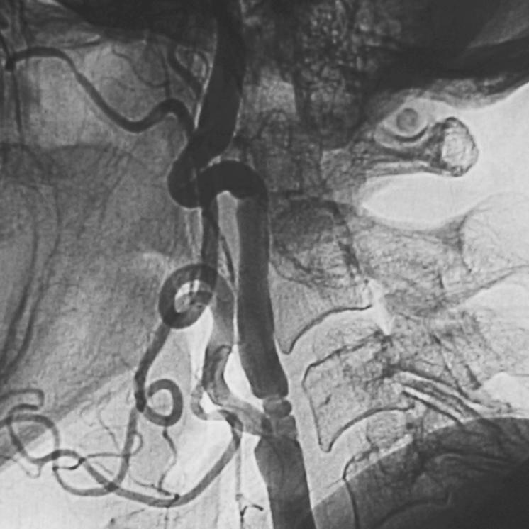 The severe stenosis (at least 80%) of the