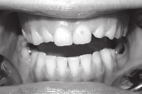 124 N. Stojanović, J. Krunić Balk J Stom, Vol 13, 2009 Clinical Examination The patient s oral hygiene was good, with some pigmented plaque on mandibular molars. No calculus was present.