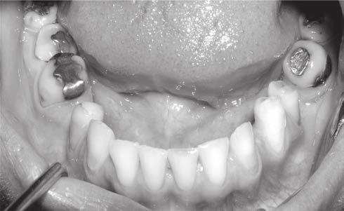 Balk J Stom, Vol 13, 2009 Extensive Tooth Wear 125 Groups of teeth cervical buccal lingual occlusal/incisal anterior maxillary 0.83 ± 0.75 1.00 ± 0.89 4.00 ± 0.00 1.67 ± 1.03 posterior maxillary 0.