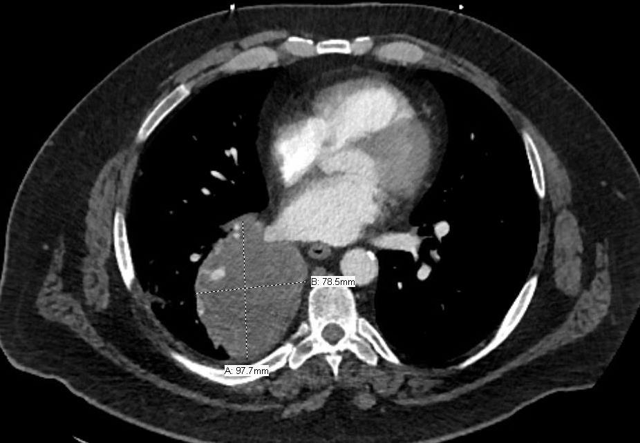 Right lower pulmonary primary and multiple enlarged mediastinal lymph nodes (right subcarinal 1.