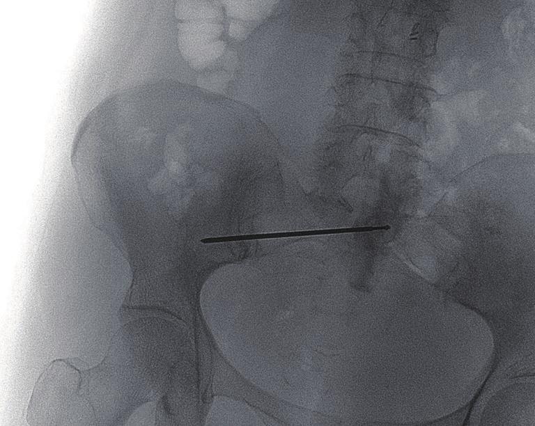 A computed tomography (CT) scan completed in December revealed a sacral insufficiency, most likely induced by radiation, at high risk of fracture.