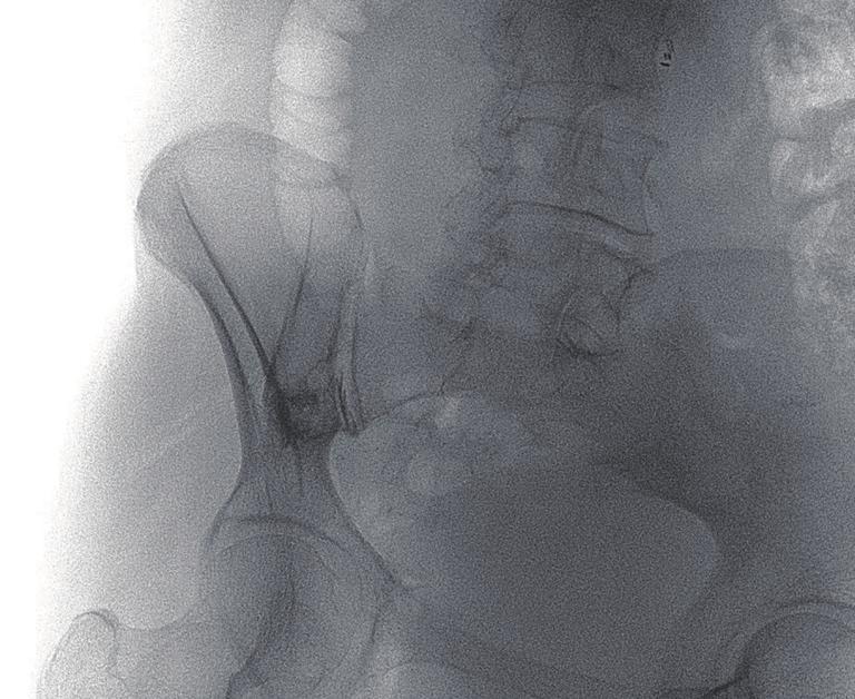 Bilateral lesions most likely coincide with radiation-induced insufficiency fractures as it is uncommon that bone metastases develop symmetrically.