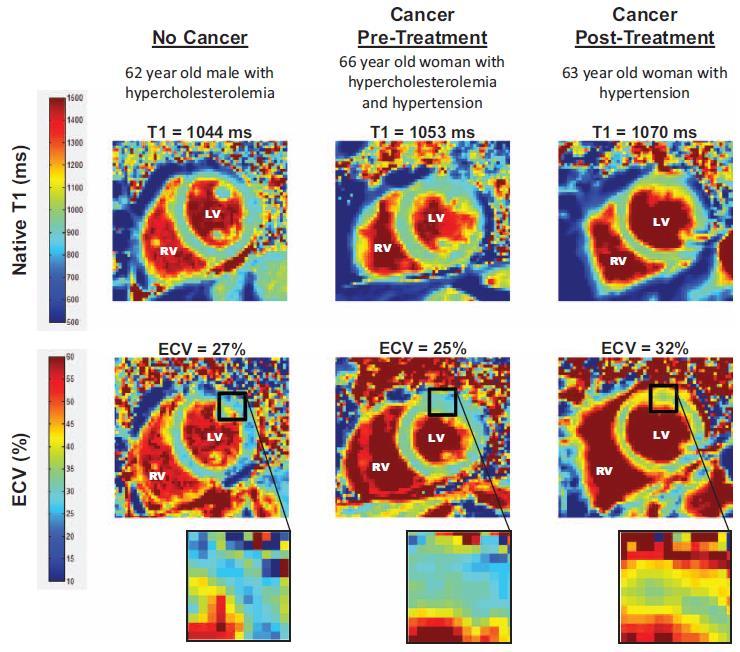 quantitative insight into myocardial tissue through T1/T2 mapping, extracellular volume