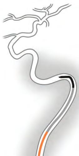 038" guidewires Preload BENCHMARK 071 guide catheter with 5F Penumbra Select catheter of desired shape. Seamless transition zone with no shelf for atraumatic advancement.