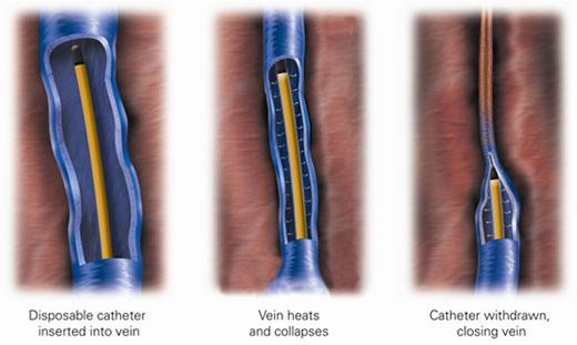 Figure 1 shows radiofrequency ablation treatment of a varicose vein What happens after RFA and when I go home? A support stocking is usually fitted on your leg after the procedure.