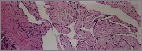 Cavernous Hemangioma Epidemiology Most common benign