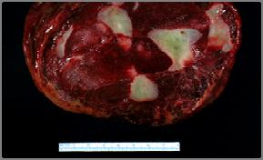Hemangioma: Histology Network of vascular spaces