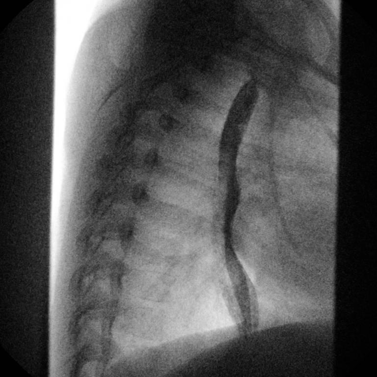 Fluoroscopy lasted 1 hour and 15 minutes, a marked